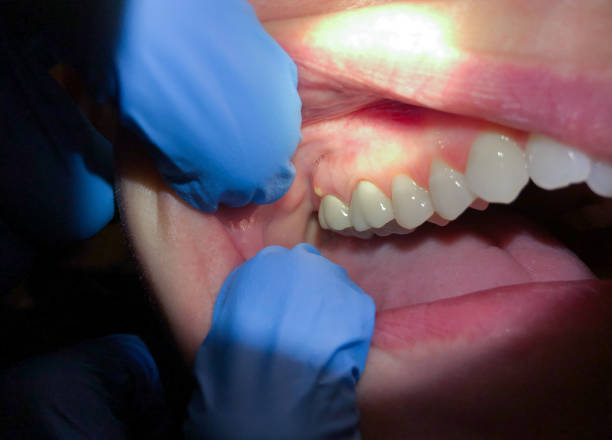 Best Emergency Denture Repair in Rossmoyne, OH